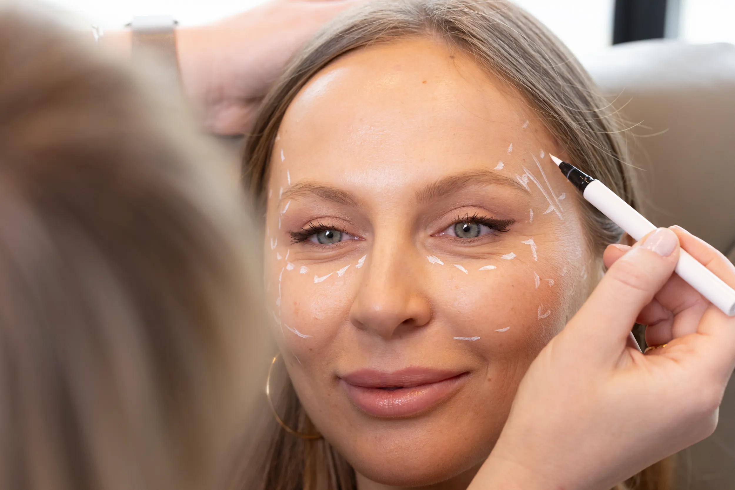 Botox להיפרהידרוזיס (הזעה מוגזמת בבתי שחי)